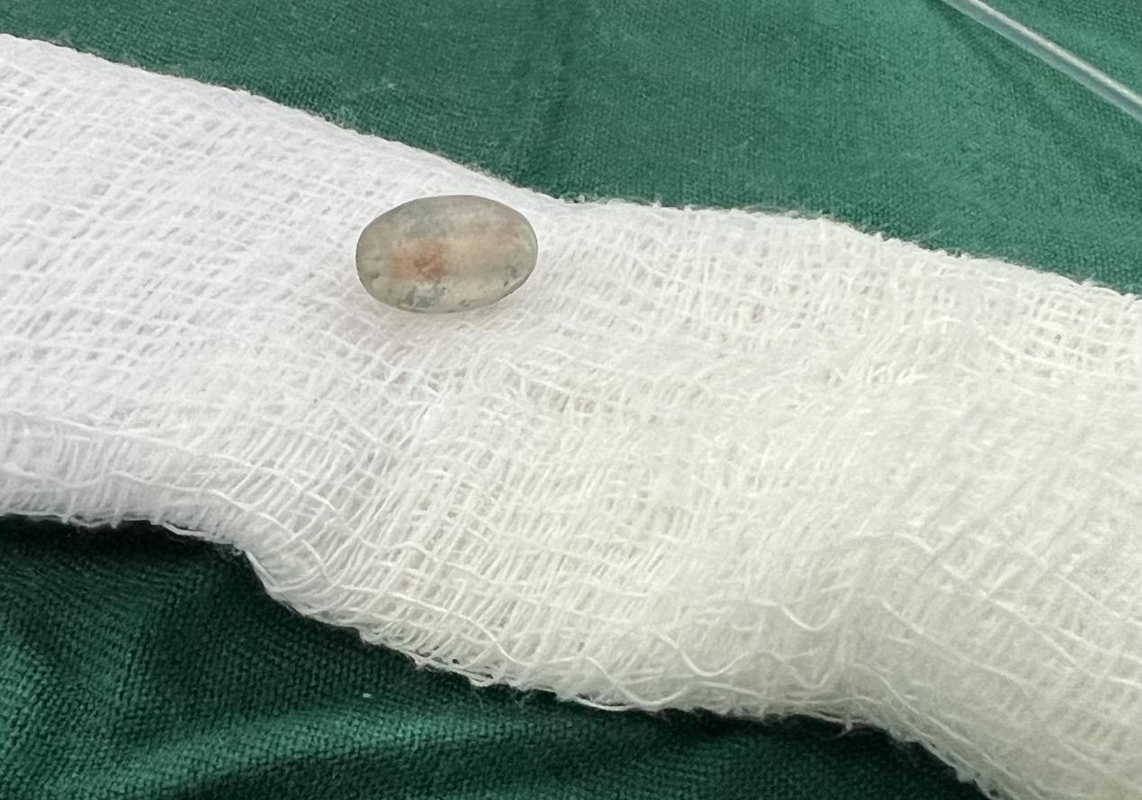 被取出的異物。中國(guó)援桑醫(yī)療隊(duì)供圖