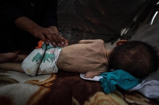 這是5月28日在加沙城西部一處臨時安置點拍攝的一名營養(yǎng)不良的嬰兒。新華社發(fā)（馬哈茂德·扎基攝）